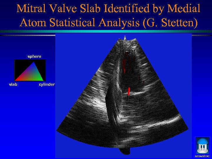 Mitral Valve Slab Identified by Medial Atom Statistical Analysis (G. Stetten) sphere slab cylinder