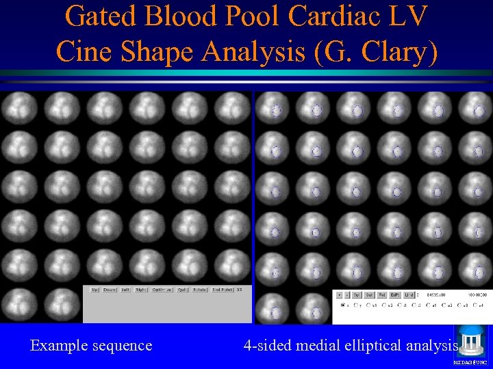 Gated Blood Pool Cardiac LV Cine Shape Analysis (G. Clary) Example sequence 4 -sided