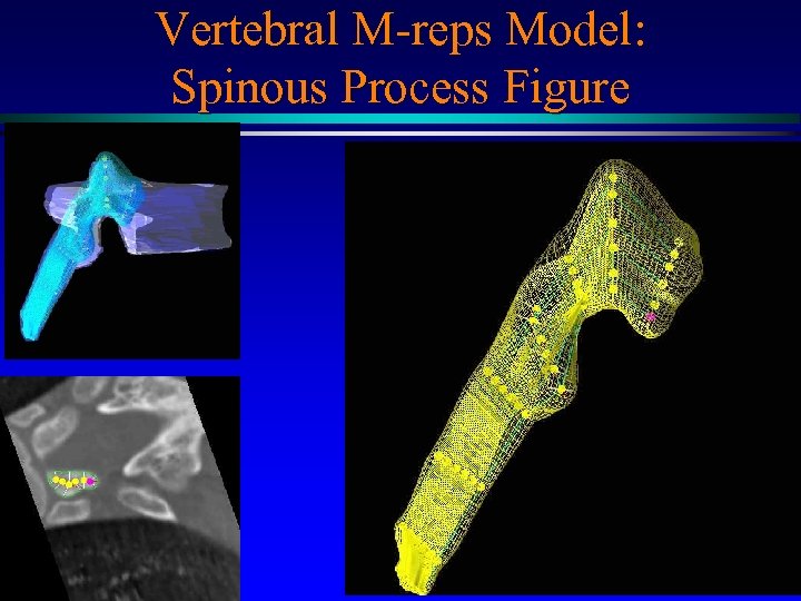 Vertebral M-reps Model: Spinous Process Figure MIDAG@UNC 