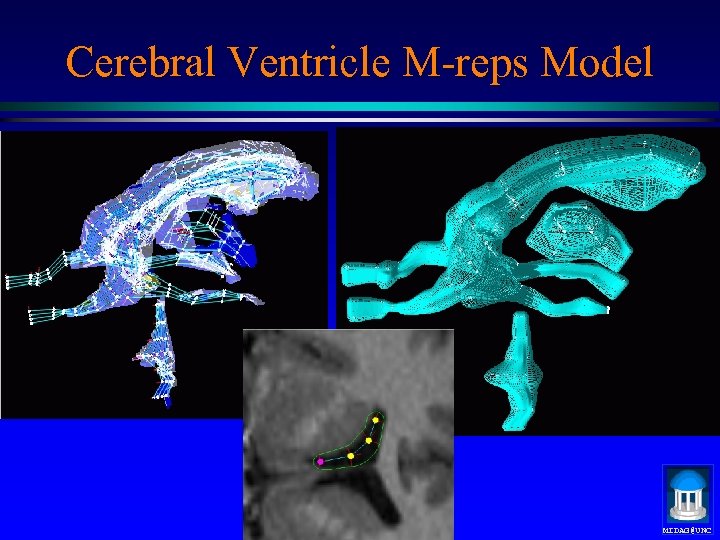 Cerebral Ventricle M-reps Model MIDAG@UNC 