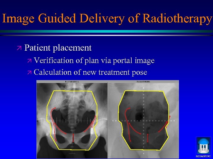 Image Guided Delivery of Radiotherapy ä Patient placement ä Verification of plan via portal