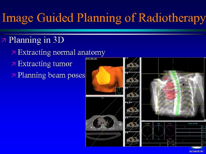 Image Guided Planning of Radiotherapy ä Planning in 3 D ä Extracting normal anatomy