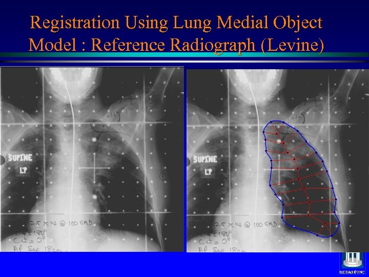 Registration Using Lung Medial Object Model : Reference Radiograph (Levine) Medial nets, positions only