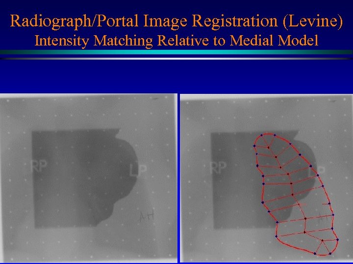 Radiograph/Portal Image Registration (Levine) Intensity Matching Relative to Medial Model Medial net MIDAG@UNC 