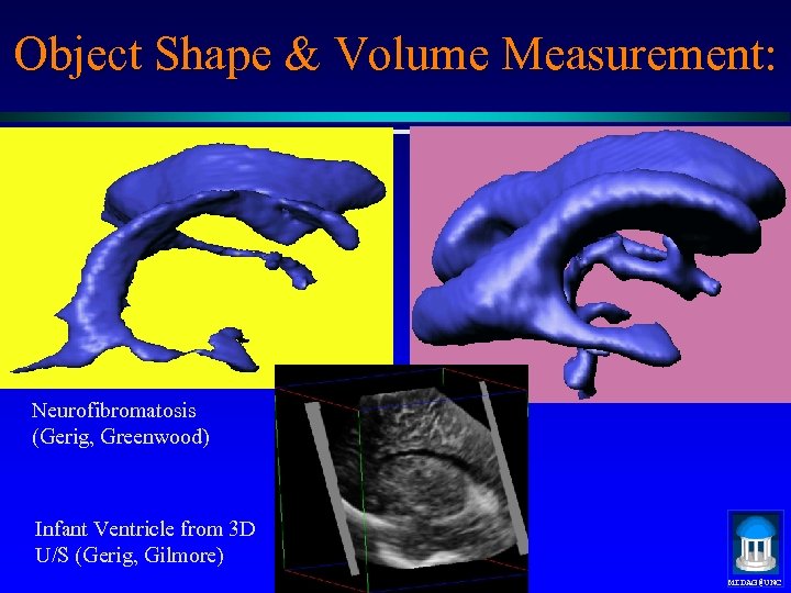 Object Shape & Volume Measurement: Neurofibromatosis (Gerig, Greenwood) Infant Ventricle from 3 D U/S