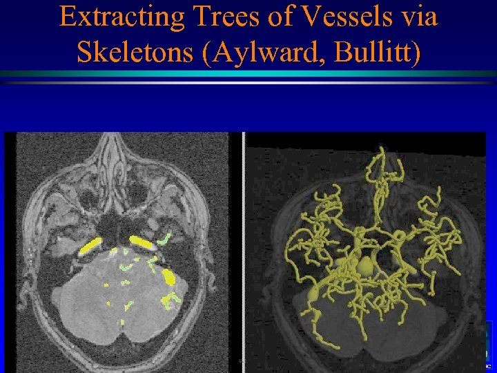 Extracting Trees of Vessels via Skeletons (Aylward, Bullitt) MIDAG@UNC 