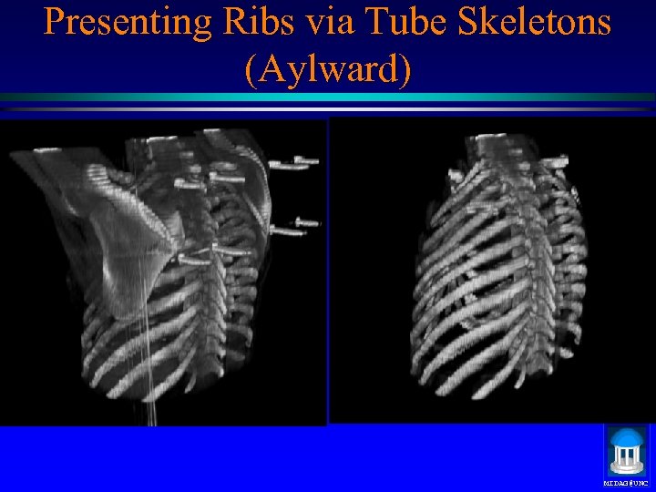 Presenting Ribs via Tube Skeletons (Aylward) MIDAG@UNC 