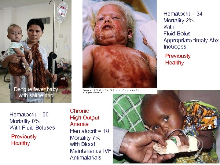 Hematocrit = 34 Mortality 2% With Fluid Bolus Appropriate timely Abx Inotropes Previously Healthy