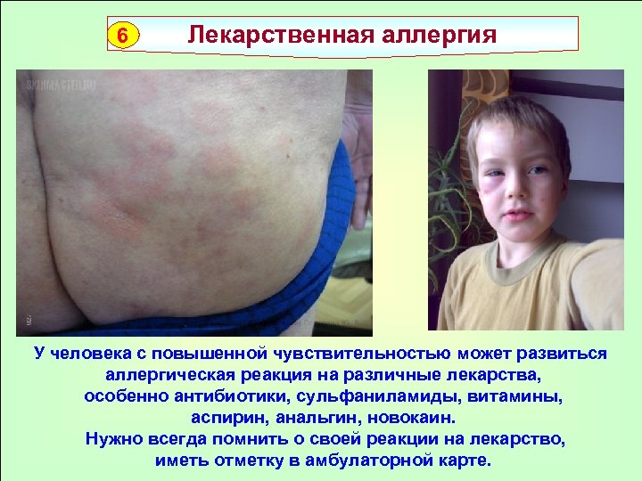 6 Лекарственная аллергия У человека с повышенной чувствительностью может развиться аллергическая реакция на различные