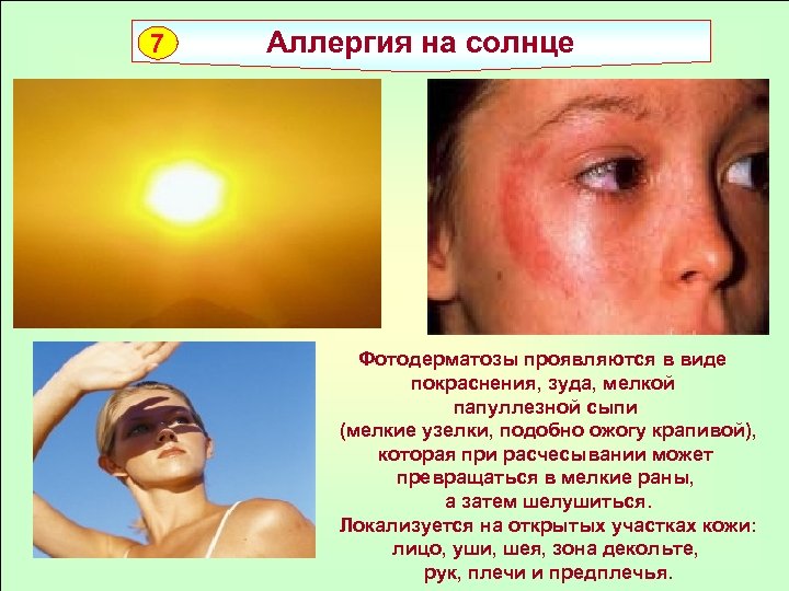 7 Аллергия на солнце Фотодерматозы проявляются в виде покраснения, зуда, мелкой папуллезной сыпи (мелкие