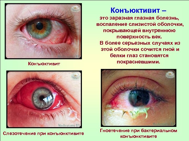 Конъюктивит – Конъюктивит Слезотечение при конъюнктивите это заразная глазная болезнь, воспаление слизистой оболочки, покрывающей