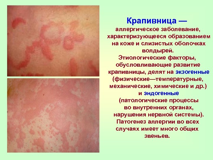 Крапивница — аллергическое заболевание, характеризующееся образованием на коже и слизистых оболочках волдырей. Этиологические факторы,