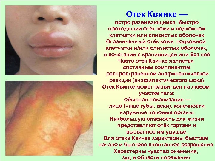 Отек Квинке — остро развивающийся, быстро проходящий отёк кожи и подкожной клетчатки или слизистых