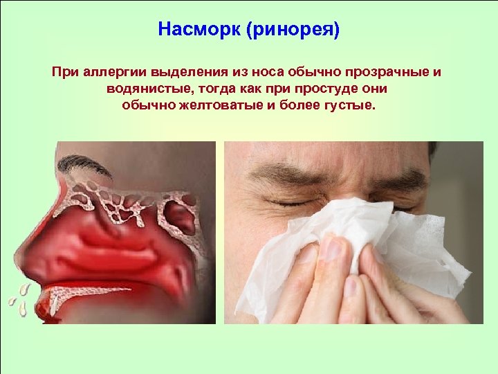 Насморк (ринорея) При аллергии выделения из носа обычно прозрачные и водянистые, тогда как при