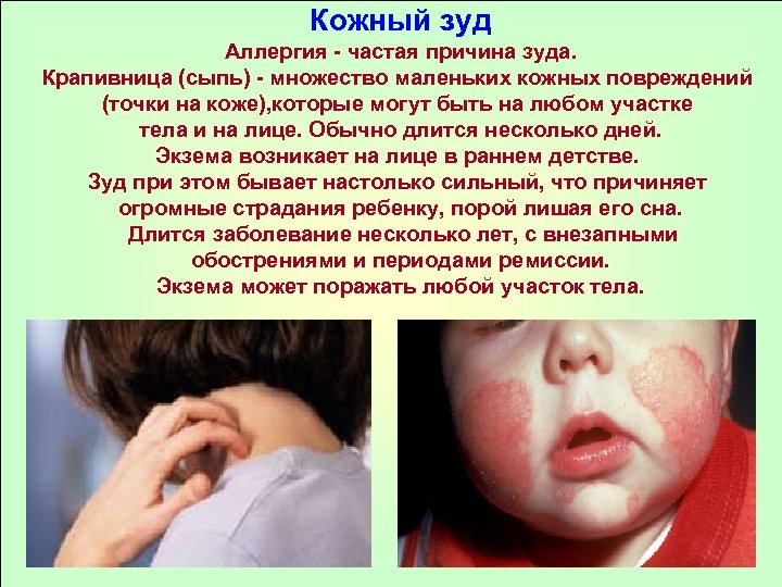 Кожный зуд Аллергия - частая причина зуда. Крапивница (сыпь) - множество маленьких кожных повреждений