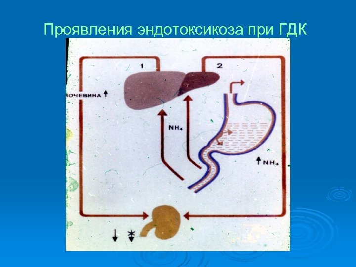 Проявления эндотоксикоза при ГДК 