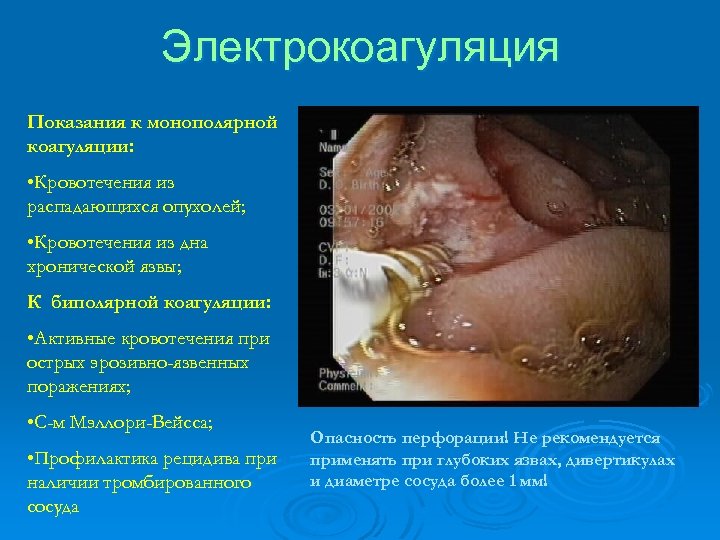Электрокоагуляция Показания к монополярной коагуляции: • Кровотечения из распадающихся опухолей; • Кровотечения из дна