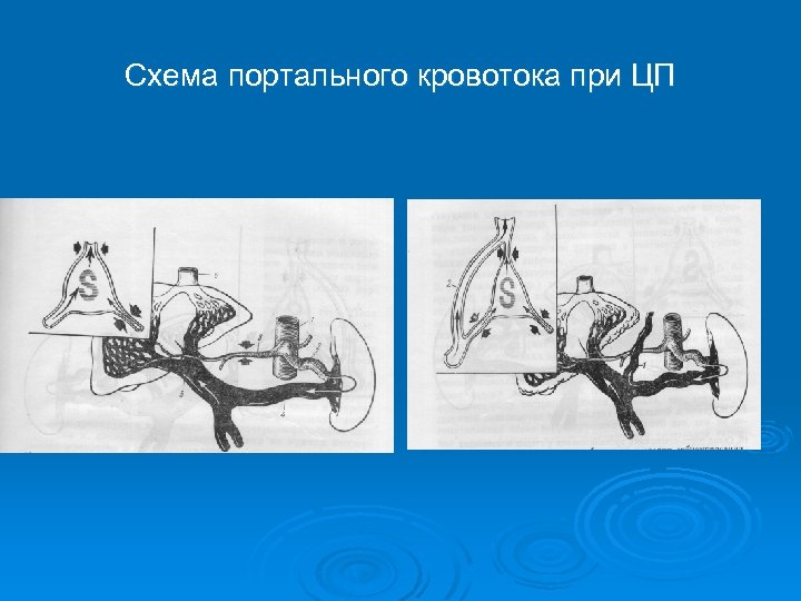 Схема портального кровотока при ЦП 