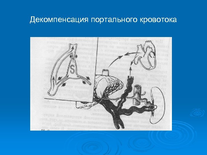 Декомпенсация портального кровотока 