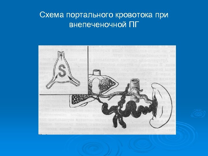 Схема портального кровотока при внепеченочной ПГ 