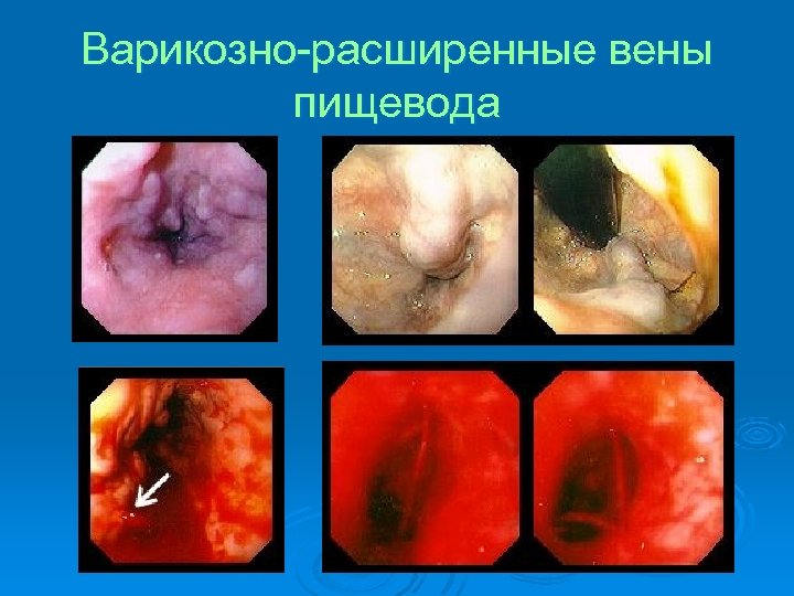 Варикозно-расширенные вены пищевода 