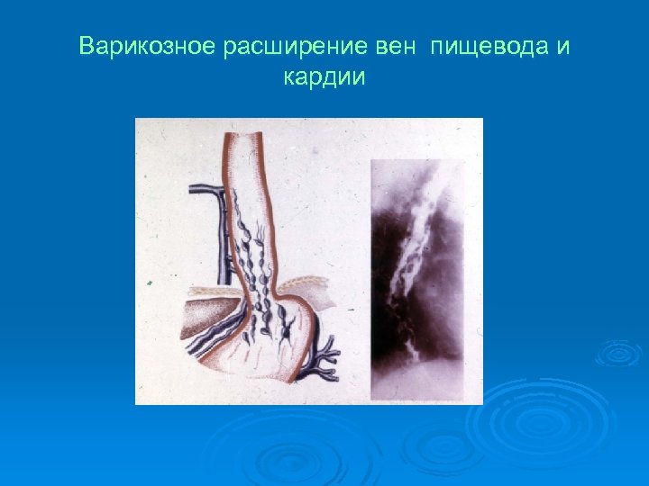 Варикозное расширение вен пищевода и кардии 