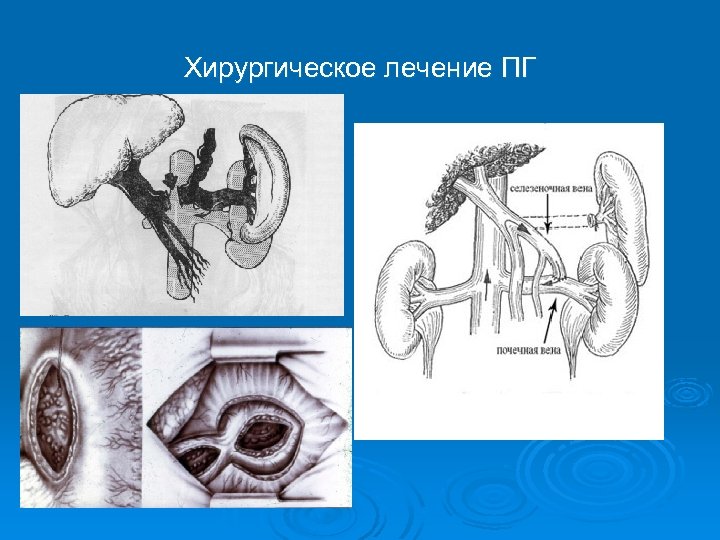 Хирургическое лечение ПГ 