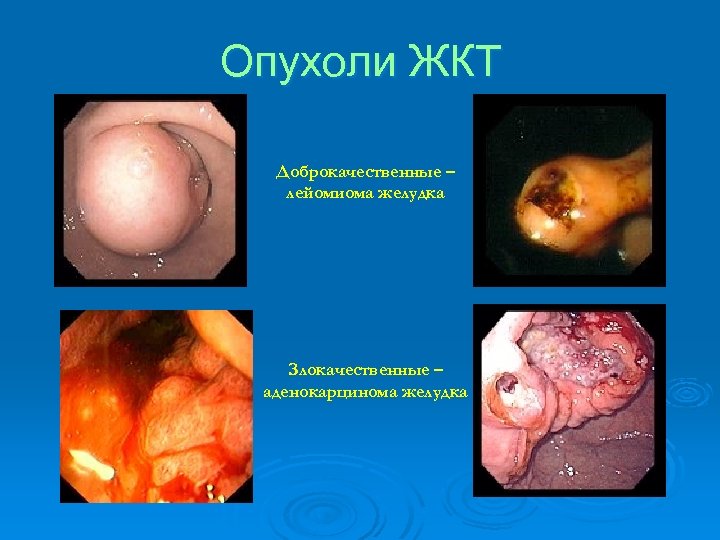 Опухоли ЖКТ Доброкачественные – лейомиома желудка Злокачественные – аденокарцинома желудка 