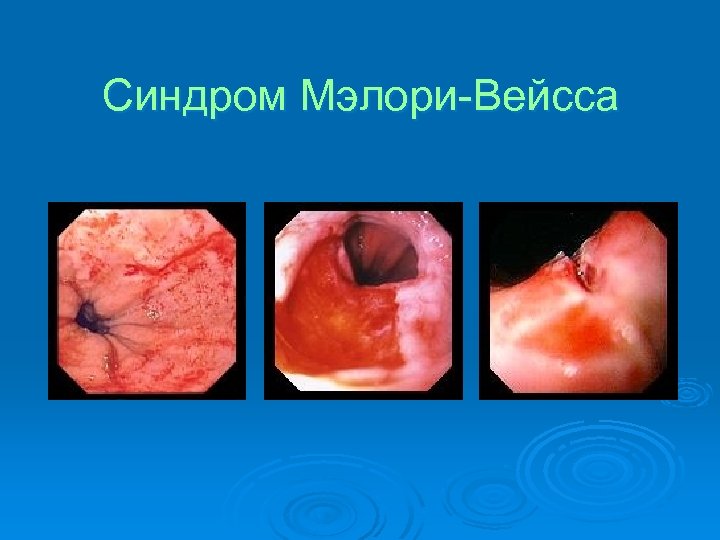 Синдром Мэлори-Вейсса 