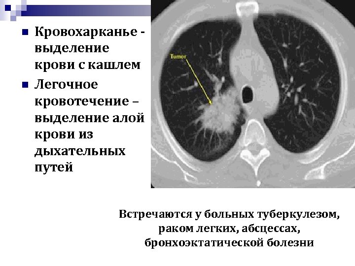 Легочные кровотечения картинки