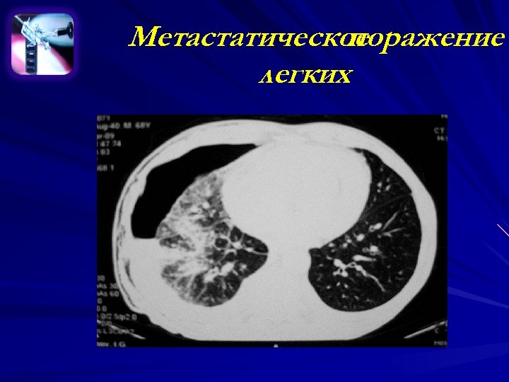 Метастатическое поражение легких 