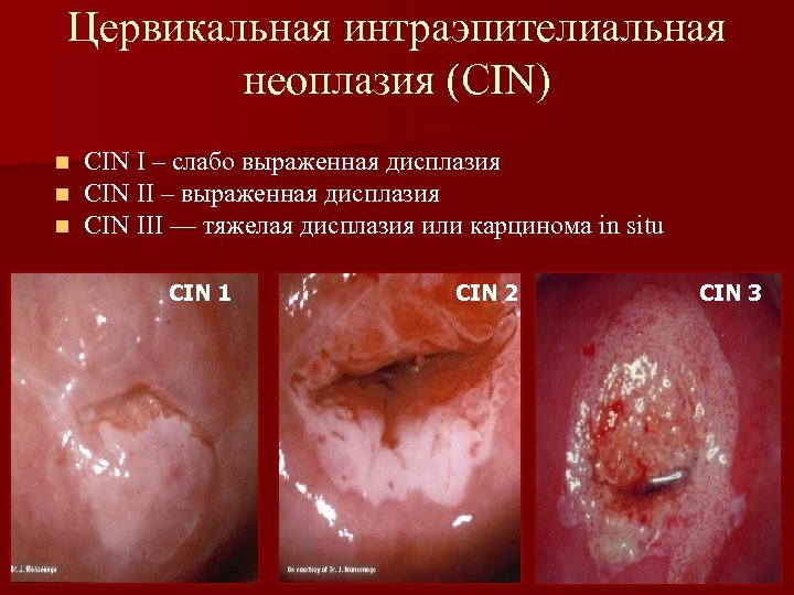 Цервикальная интраэпителиальная неоплазия (CIN) n n n CIN I – слабо выраженная дисплазия CIN