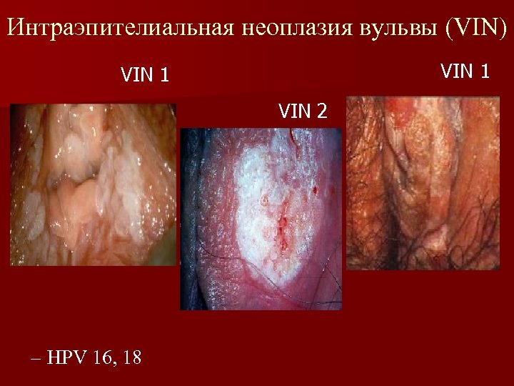 Интраэпителиальная неоплазия вульвы (VIN) VIN 1 VIN 2 – HPV 16, 18 