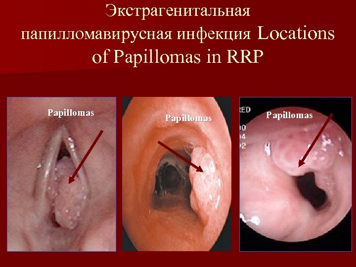 Экстрагенитальная папилломавирусная инфекция Locations of Papillomas in RRP Papillomas 