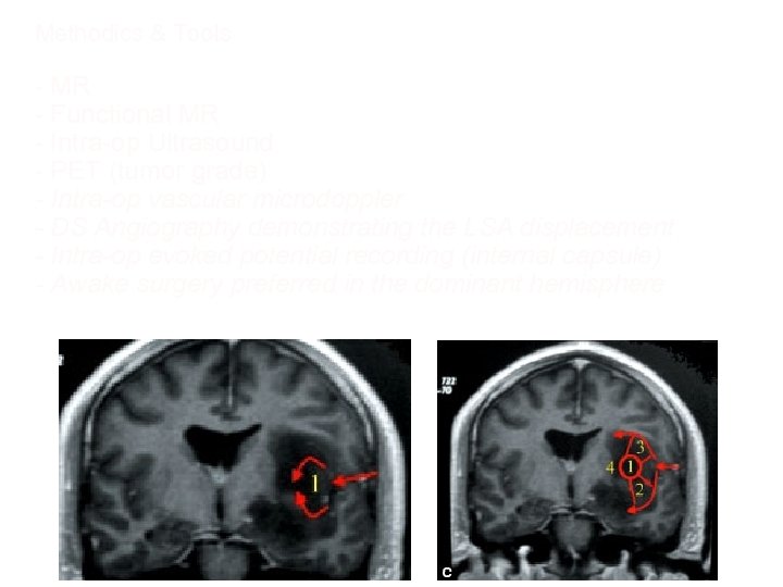 Methodics & Tools - MR - Functional MR - Intra-op Ultrasound - PET (tumor