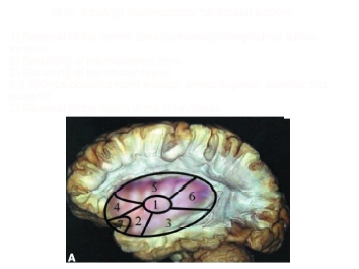M. G. Yasargil lesionectomy for insular tumors 1) Removal of the central zone performing