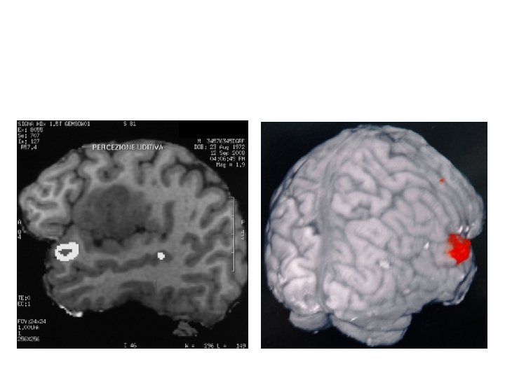 Functional MR demonstating temporal opercular region tumor involvement and uditive area to avoid during