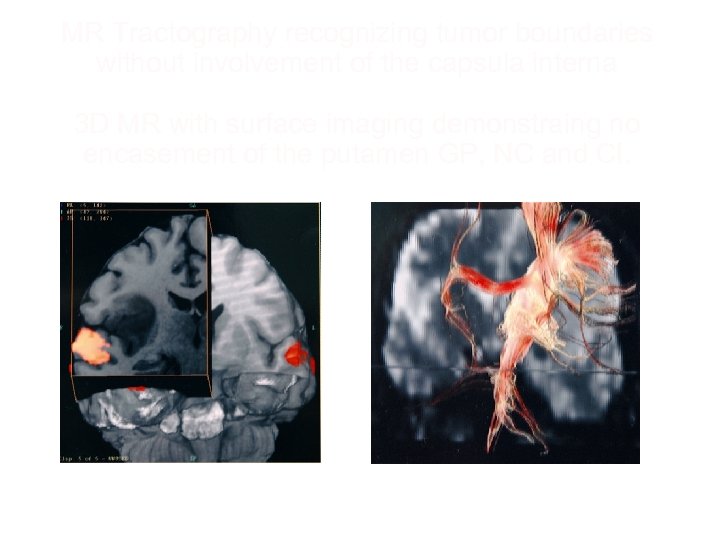 MR Tractography recognizing tumor boundaries without involvement of the capsula interna 3 D MR