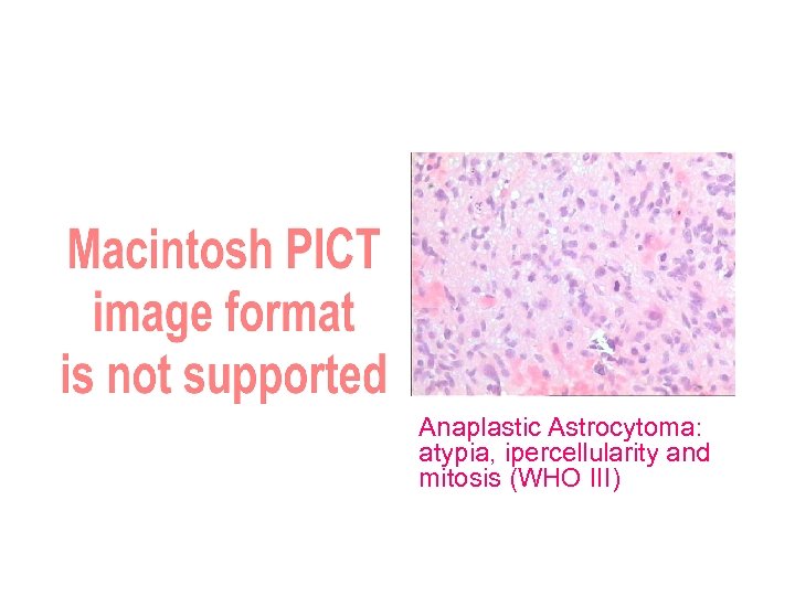 Tumor LSAs medial displacement Open biopsy: anaplastic glioma Anaplastic Astrocytoma: atypia, ipercellularity and mitosis