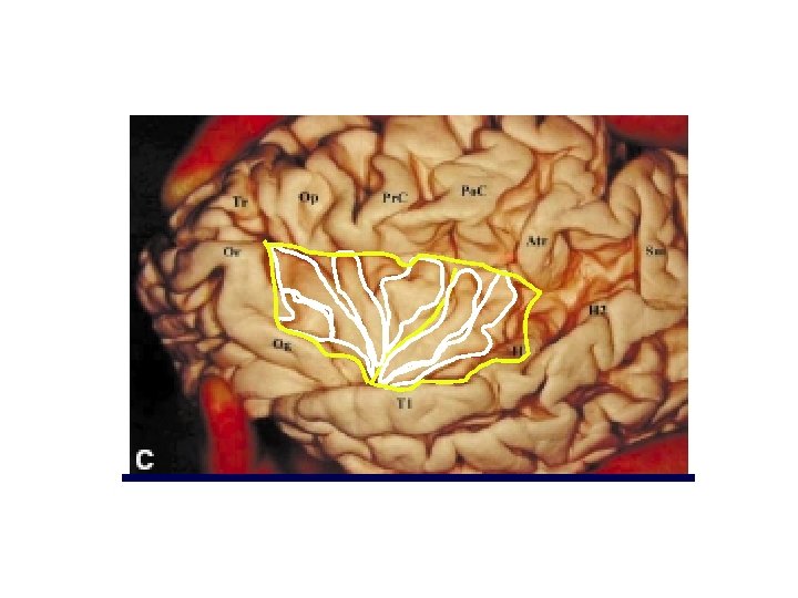 Microsurgical anatomy of the Insular Lobe 
