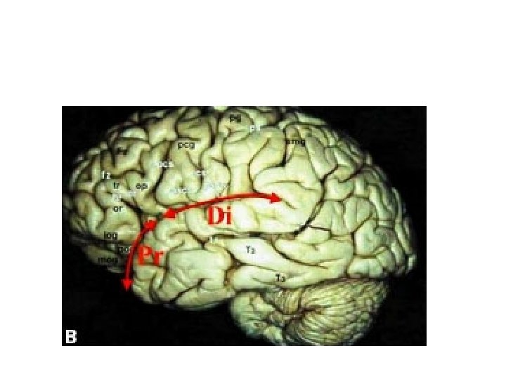 Sylvian fessure distal and prossimal division 