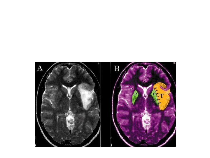T 2 sharp imaging on benign tumor M. G. Yasargil, Ali F. Krisht, Ugur