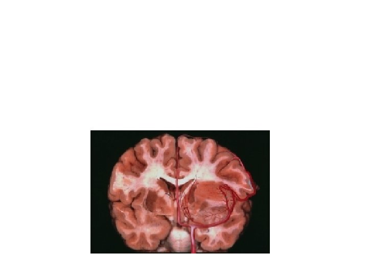 Lesion displacing LSAs medially often represent a sharp-well demarcated T 2 MR images and