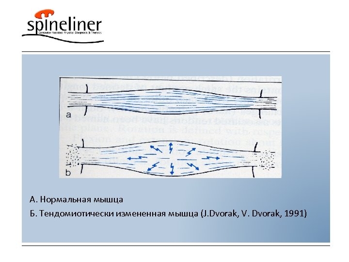 А. Нормальная мышца Б. Тендомиотически измененная мышца (J. Dvorak, V. Dvorak, 1991) 