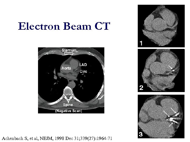 Electron Beam CT Achenbach S, et al, NEJM, 1998 Dec 31; 339(27): 1964 -71