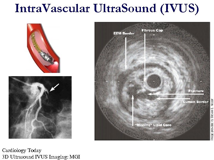 Intra. Vascular Ultra. Sound (IVUS) Cardiology Today 3 D Ultrasound IVUS Imaging: MGI 