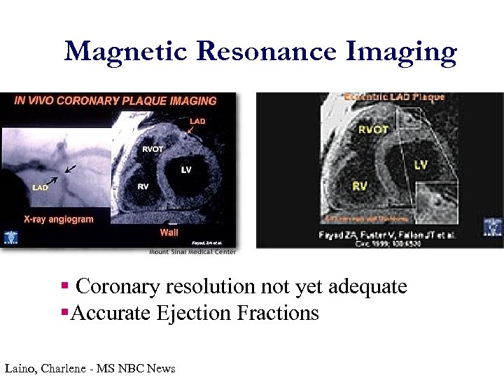 Magnetic Resonance Imaging § Coronary resolution not yet adequate §Accurate Ejection Fractions Laino, Charlene