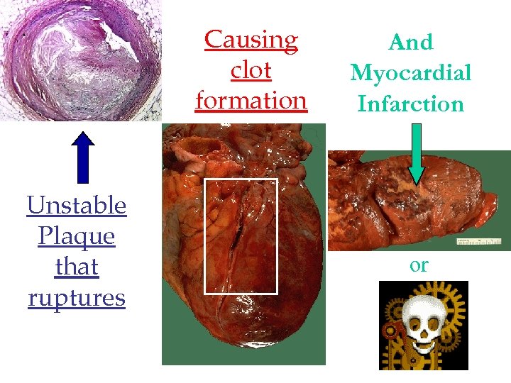 Causing clot formation Unstable Plaque that ruptures And Myocardial Infarction or 