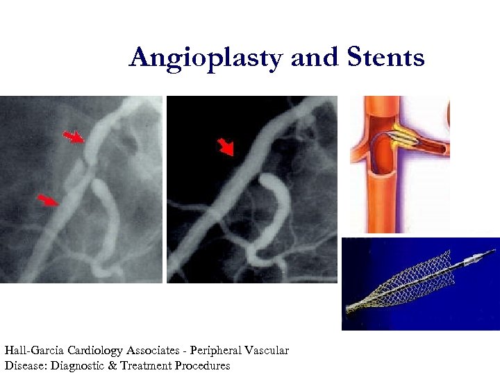 Angioplasty and Stents Hall-Garcia Cardiology Associates - Peripheral Vascular Disease: Diagnostic & Treatment Procedures