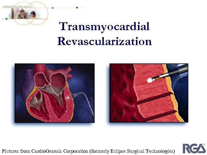 Transmyocardial Revascularization Pictures from Cardio. Genesis Corporation (formerly Eclipse Surgical Technologies) 